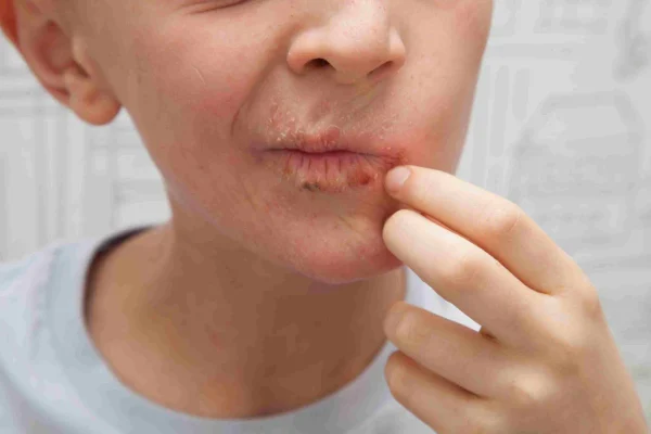 5 Tips Menghindari Alergi pada Bibir 5 Tips Menghindari Alergi pada Bibir