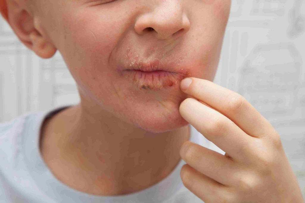 5 Tips Menghindari Alergi pada Bibir