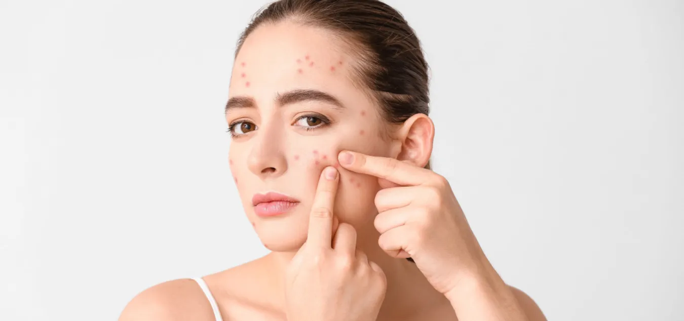 7 Kebiasaan Buruk yang Bikin Jerawat Makin Parah