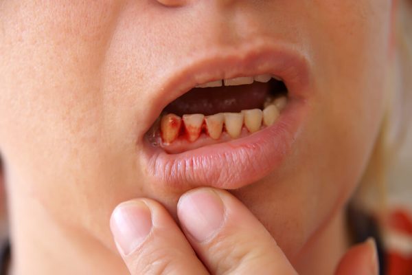 5 Alasan Gusi Bisa Berdarah saat Sikat Gigi 5 Alasan Gusi Bisa Berdarah saat Sikat Gigi