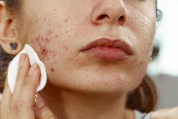 7 Cara Mengatasi Jerawat Hormonal Tanpa Obat Dokter