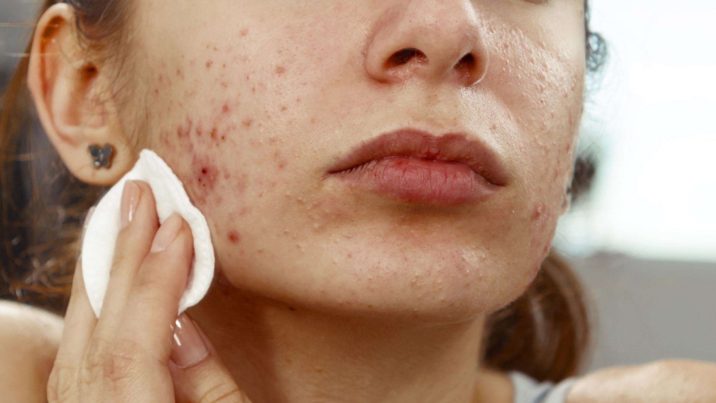 7 Cara Mengatasi Jerawat Hormonal Tanpa Obat Dokter