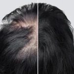10 Cara Merawat Rambut Rontok Karena Stres