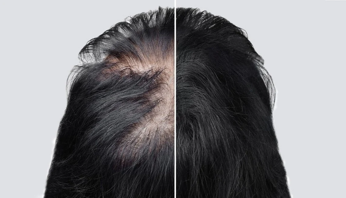 10 Cara Merawat Rambut Rontok Karena Stres